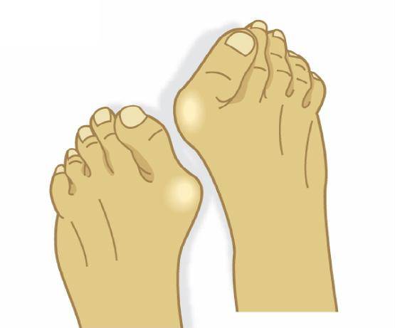 [헬스조선]기형이 일어난 발 /사진=조선일보 DB