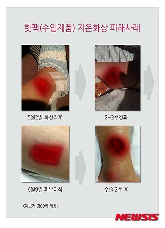 핫팩 저온화상, 핫팩(수입제품) 저온화상 피해사례
