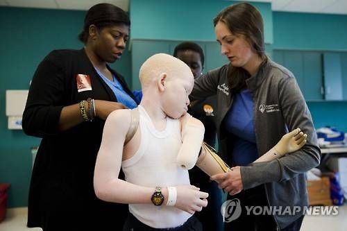 국제구호단체로부터 의수를 지원받고 있는 탄자니아의 알비노 어린이(AP=연합뉴스)