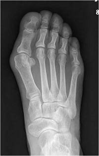 [헬스조선]소건막류는 새끼발가락이 엄지발가락 쪽을 향해 휘는 것으로 자신의 발볼보다 작은 신발을 오랫동안 신었을 때 발병한다/사진=헬스조선 DB