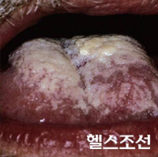 [헬스조선]