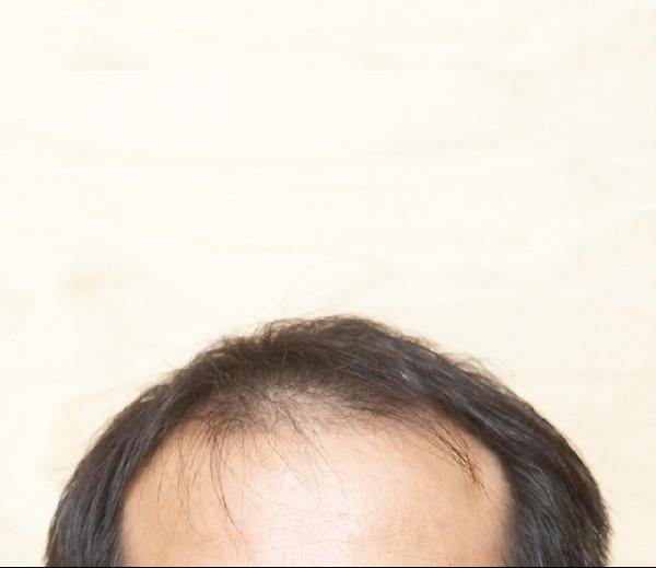 [헬스조선]탈모는 종류에 따라 원인과 치료법이 다르다/사진=헬스조선 DB