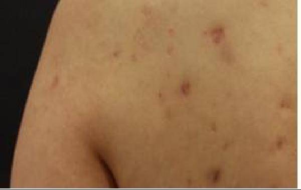 [헬스조선]몸에 나는 여드름은 염증이 깊고 크기도 큰 편이다. 조기에 발견하고 관리·치료하는 게 안전하다./사진=아름다운나라피부과 제공