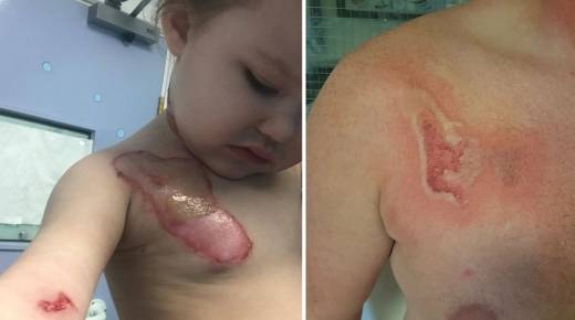 아빠 카일은 딸의 오른쪽 가슴에 있는 흉터 모양의 문신을 같은 위치에 새겼다. (사진=메트로, 키즈스팟)