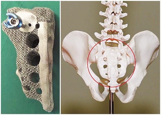 세브란스병원이 골육종을 앓던 여학생의 몸에 꼭 맞게 3D 프린팅 기술로 제작한 왼쪽 골반뼈. 오른쪽 사진은 골반뼈 위치를 보여주는 모형이다.   세브란스병원 제공