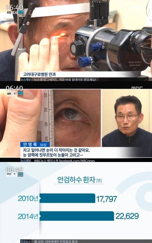 사진:안검하수 증상