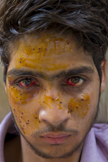인도령 카슈미르에서 카슈미리 독립을 요구하는 시위를 하다 산탄총에 눈을 다쳐 실명 위기에 놓인 시위대 [사진= 인디언 타임스 캡처]
