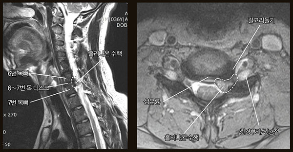 증상 발생 7일째 촬영한 목 MRI 영상. 왼쪽 사진에서 6~7번 목 디스크의 뒤쪽으로 수핵이 흘러나온 것(점선 안)을 확인할 수 있다. 이 부분을 수평 단면으로 보면(오른쪽) 동그란 디스크 가운데 있던 수핵이 뒤쪽 섬유륜을 찢고 흘러나와 신경절과 신경뿌리에 매우 가깝게 닿아 있다.