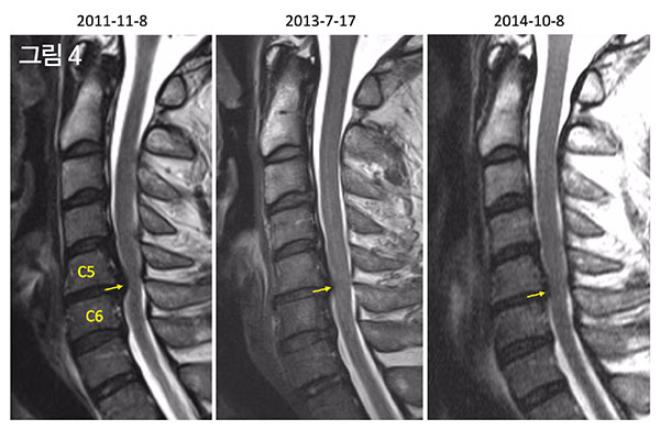 정선근 교수의 2011년(왼쪽) 2013년(가운데) 2014년(오른쪽) 목 디스크 MRI. 목 디스크가 점점 정상화되고 있다.