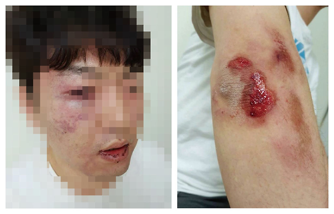 아래 사진은 경찰관들의 폭행으로 얼굴에 멍이 들고 팔에 상처를 입은 A씨 © 온라인 커뮤니티