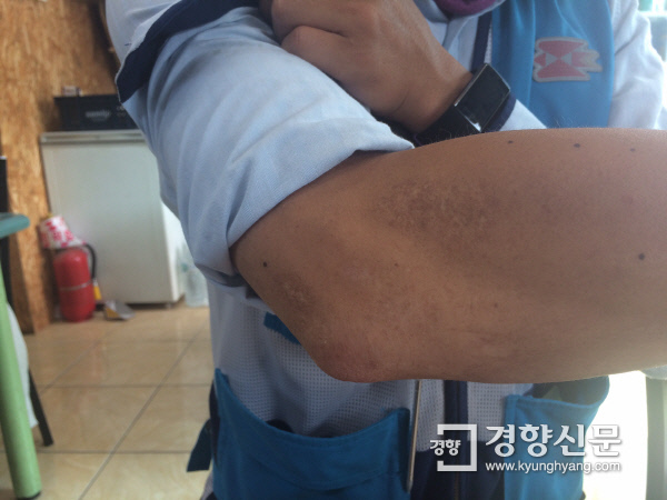 오토바이 사고로 입었던 상처들이 정씨의 팔에 흉터로 남아있다. 김지혜 기자