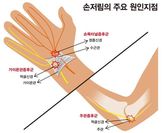 추석 뒤 주부에게 나타날 수 있는 손 저림은 질환에 따라 증상이 나타나는 부위가 다르다. 질환별 손 저림이 나타나는 부위. [자료=연세정형외과]