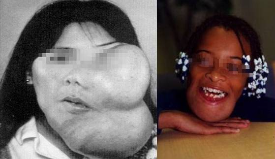 종양이 다발성으로 팽창하며 안면이 변형된 유전성 거대백악종 환자들. [사진 이종호]