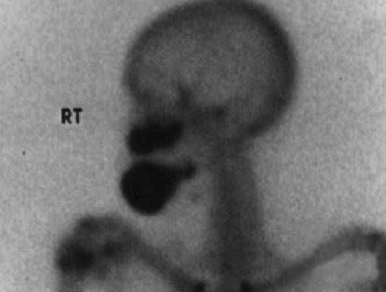 유전성 거대백악종 환자의 뼈 스캔 사진. 방사선이 투과하지 못해 검게 나타난 부분이 종양이다. [사진 이종호]