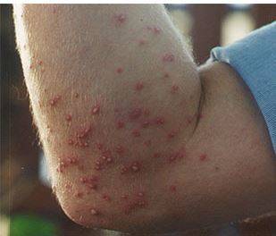 붉은불개미에 물린 사진. 불에 데인 것 같은 통증에 불개미라 한다. [중앙포토]