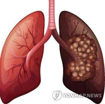 폐암 [게티이미지뱅크 제공 = 연합뉴스 자료사진]