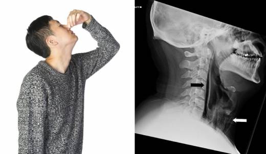 “재채기할 때 코·입 막으면 식도 근처 파열”