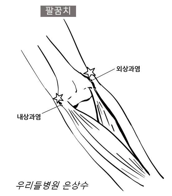 외상과염과 내상과염 / 사진-은상수 전문의 제공