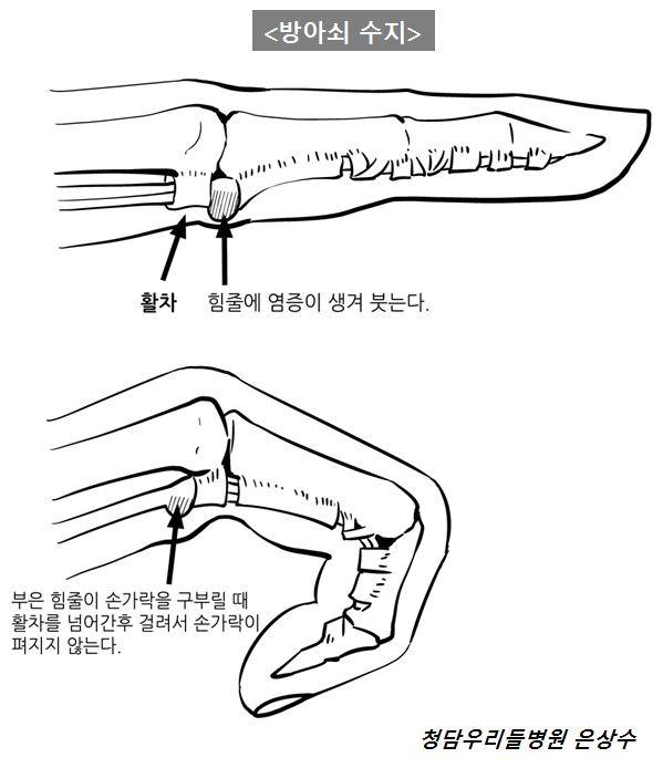 방아쇠 수지가 나타난 손가락 /사진-은상수 전문의 제공