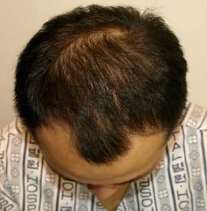 유전에 의한 탈모 사례 1. 이마의 M자 부위가 비어보이고 정수리 부분의 모발이 가늘어져 있다.