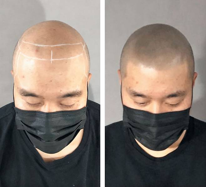 대머리 디자인 전후 모습. 삭발한 대머리 위에 촘촘히 점을 찍어 대머리에 남은 탈모 흔적을 가린다./디크리스 제공