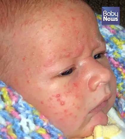 신생아 여드름(사진 3). ⓒ박준수