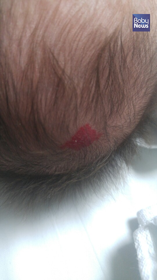 혈관종(사진 6). ⓒ박준수