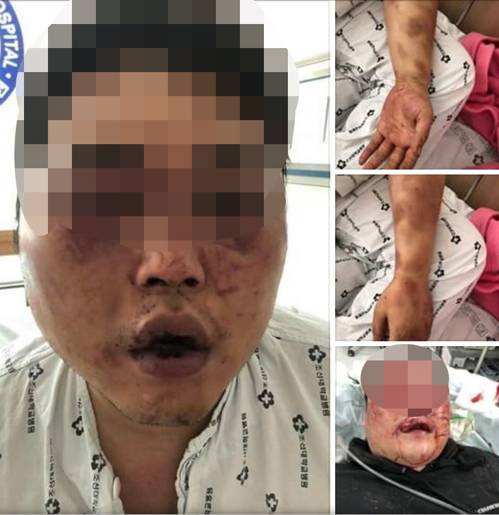 집단폭행으로 실명 위기 처한 피해자 [페이스북 페이지 캡처=연합뉴스]