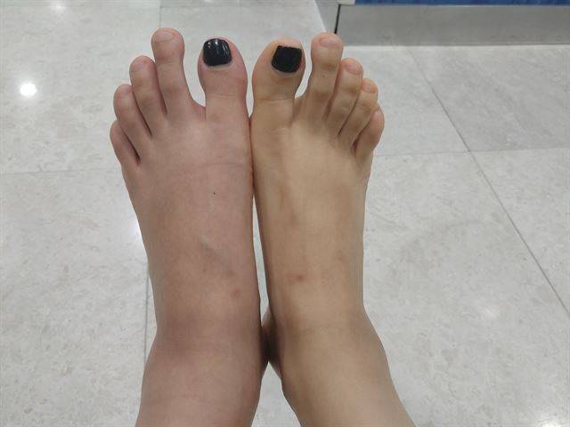 지난해 10월 인천의 모 대학병원에서 심부정맥혈전증을 진단받아 시술을 받은 후 왼쪽 발가락, 무릎 등에 신경 운동감각 마비가 온 김모(37ㆍ여)씨가 제보한 발 사진.