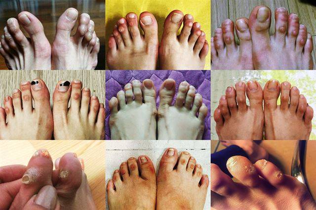 백화점 및 면세점 등에서 유명 화장품을 판매하는 여성 노동자들은 신체적, 정신적으로 다양한 질병을 앓고 있다. 특히, 발에 맞지 않는 ‘유니화’를 신고 종일 서서 일하다 보면 체중이 발에 집중되면서 무지외반증과 같은 족부 질환에 걸리기 십상이다. 수술 외 치료법은 일하는 틈틈이 휴식을 취하는 것뿐이지만 이들의 일터는 휴식을 위한 의자마저 허락하지 않는다. 휘어지고 굳은살 박인 못생긴 발은 멀쩡한 겉모습과 달리 속으로 곪아가는 이들의 현실을 닮았다. 판매직 노동자들이 스스로 촬영한 발 사진을 민노총 서비스연맹을 통해 제공받았다.