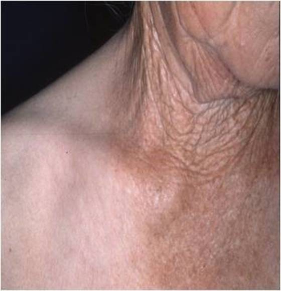 옷 속에 가려진 피부에 비해 자외선에 노출된 피부는 노화가 더 빠르게 진행된다. [중앙포토]