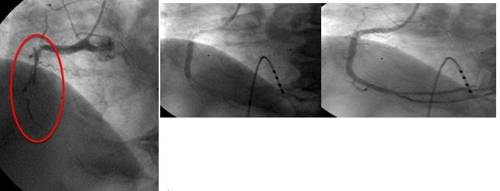 (좌)심근경색 스텐트 시술 전 (가운데)스텐트 시술 (우)스텐트 시술 후 [강남세브란스병원 제공=연합뉴스]