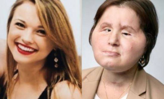 케이티 스터블필드의 사고 전 모습(왼쪽)과 안면이식수술을 받은 후 모습. 스터블필드는 18세였던 2014년 3월 25일 당시 사귀던 남자친구로부터 결별 통보를 받은 뒤 친오빠 집 화장실에서 총으로 자신의 얼굴을 쐈다. CNN 페이스북 캡처