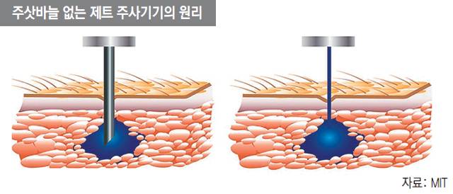 제트 주사기기(오른쪽)는 일반적인 주사기와 달리 주삿바늘이 없다. 약물을 머리카락 굵기보다 얇은 물줄기로 순간적으로(초속 200m) 내보내기 때문에 고통이 느껴지지 않는다.