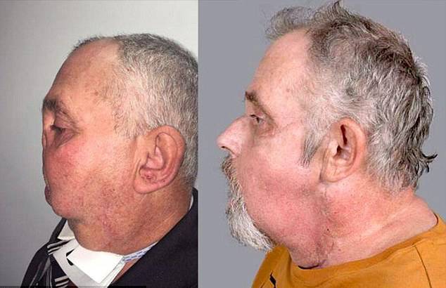 왼쪽은 수술 전, 오른쪽은 수술 후 모습