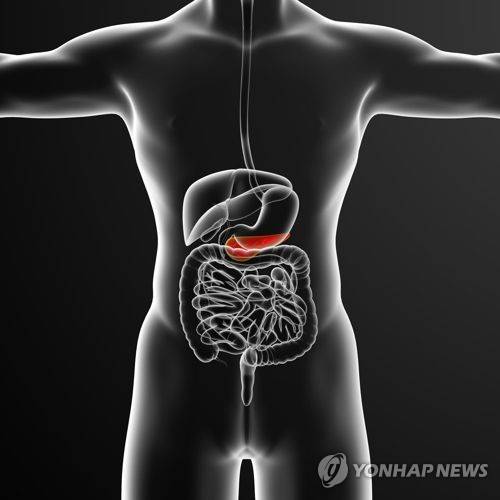 스웨덴 연구팀, 췌장암 초기 진단 혈액검사법 개발