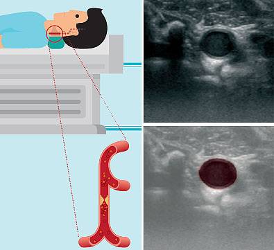 (왼쪽)경동맥 초음파 영상. 가운데 동그란 부분이 경동맥 혈관의 단면이다. 아래쪽은 경동맥만을 분리해낸 뒤 원래 영상에 덧씌워 정확히 분리됐는지 확인한 것이다. 국가수리과학연구소 제공