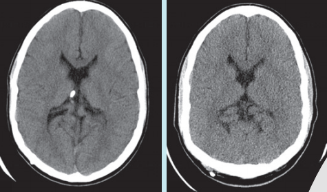방사선량을 높게 해서 찍은 어린이 환자의 뇌(왼쪽)와 방사선량을 줄여서 찍은 뇌 영상(오른쪽). 화질이 나쁘면 정확한 진단을 하기가 어렵다. American Journal of Neuroradiology 제공