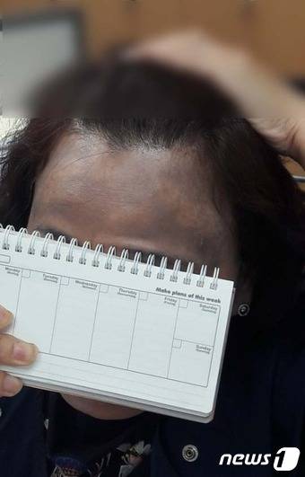 헤나 방 시술 이후 피해자 모습© News1