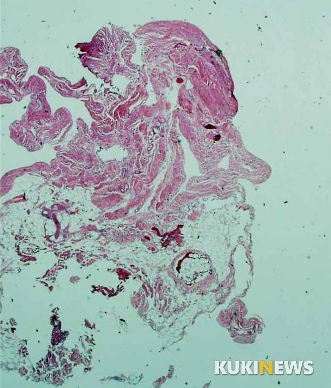 흰수염 할아버지(grandpa) :  무릎수술을 통해 제거된 연부조직이다. 정상이라 병리학적으로는 의미가 없는 조직이지만 다른 눈으로 관찰하니 흰수염 할아버지가 보인다.