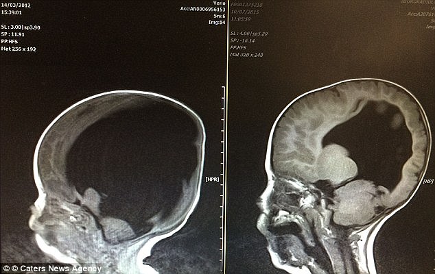 노아가 태어났을 당시인 2010년 뇌 사진(왼쪽)과 3년 후 회복된 뇌 사진(오른쪽)
