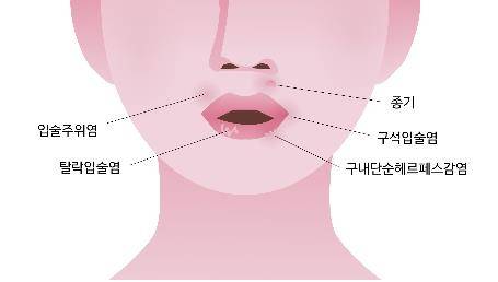 입 주변 뾰루지 [을지병원 제공]