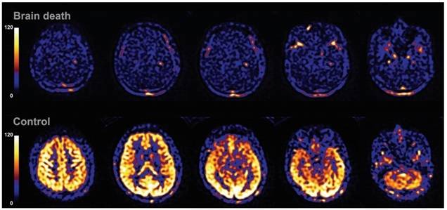 뇌사자와 일반인(의과대학생) 뇌를 기능적 자기공명영상법(functional MRI)을 통해 촬영하여 대뇌 혈류(cerebral blood flow)를 확인한 영상으로 뇌사자에서 혈류는 거의 관찰되지 않는다. 조영제를 사용한 촬영을 통해 대뇌 혈류를 확인하는 것이 표준적인 방법이지만 가족이 신체에 손대는 것을 원하지 않아 연구자들은 자기공명영상으로 이를 대체했다. 출처: 논문[6]