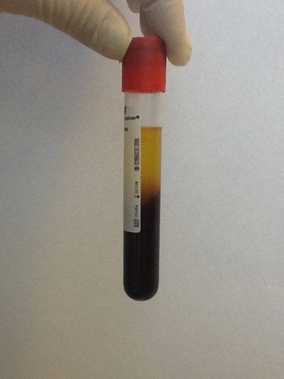 원심분리기로 분리한 피의 모습. 윗부분 노란색이 혈장이다. 그 아래가 과립 부분으로 중간에 백혈구와 혈소판이 있고, 아래에 적혈구가 있다. [중앙포토]