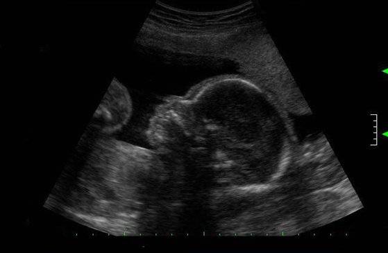 태아 초음파 사진 [중앙포토]