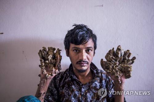 2019년 6월 24일 방글라데시 다카의대병원에서 촬영한 방글라데시 '나무인간' 아불 바잔다르의 모습. [AFP=연합뉴스]