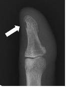 손가락 끝 사구체종양 [고대안암병원 제공]