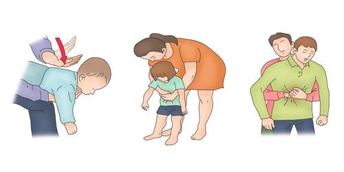 명절 음식을 과식하여 급체하거나 기도가 막혔을 경우에 대비해 미리 응급처지법을 숙지해두면 효과적으로 대처할 수 있다. 서울아산병원 제공