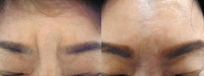 미간 주름에 ‘제이(J)자가진피재생술’을 하기 전(왼쪽)과 시술 후 8년이 지난 환자의 모습. 시술 후 눈에 띄게 개선된 미간 주름이 지금까지 유지되고 있다./진성형외과 제공