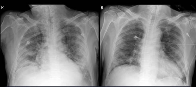 코로나19 확진자 김모(71·남)씨 엑스레이 사진./사진=세브란스병원